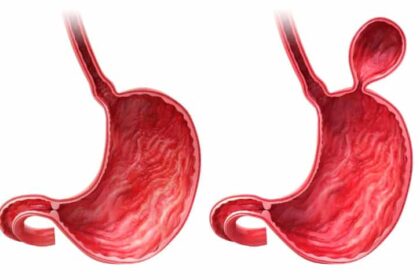 A quel âge peut survenir une hernie hiatale